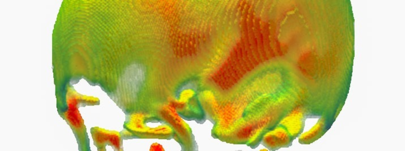 Elevated translocator protein in skull bone marrow is linked to human chronic pain